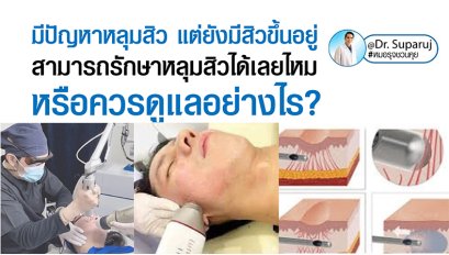 มีปัญหาหลุมสิว แต่ยังมีสิวขึ้นอยู่ สามารถรักษาหลุมสิวได้เลยไหม หรือควรดูแลอย่างไร?